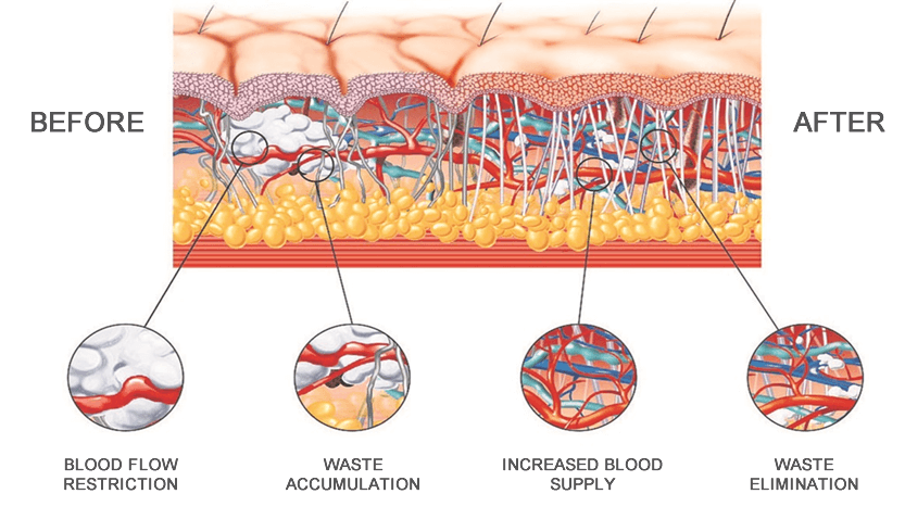 Benefits of shockwave therapy