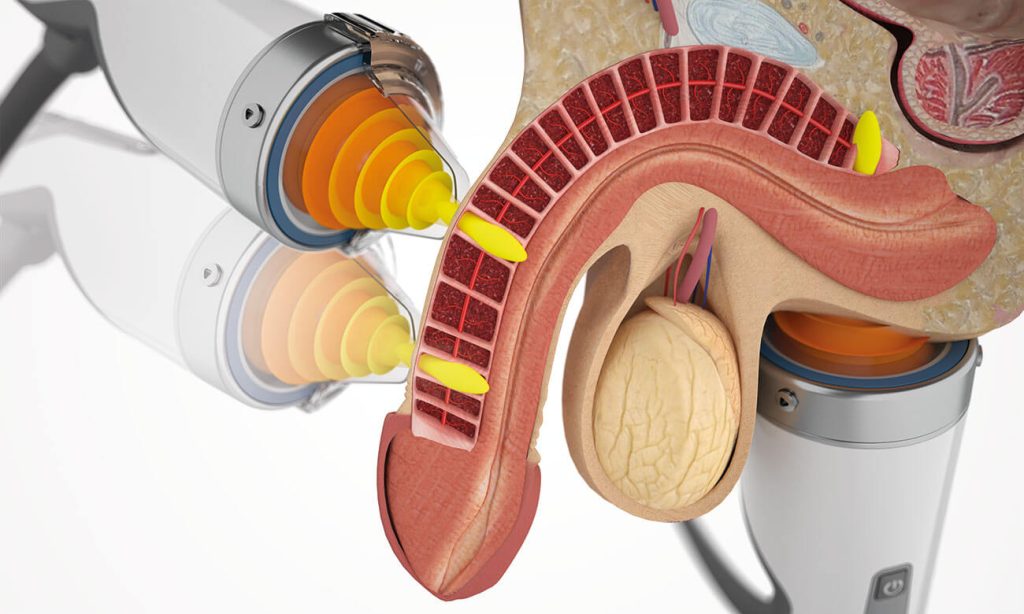 shockwave therapy for erectile dysfunction