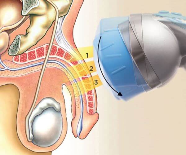 ESWT-Treatment