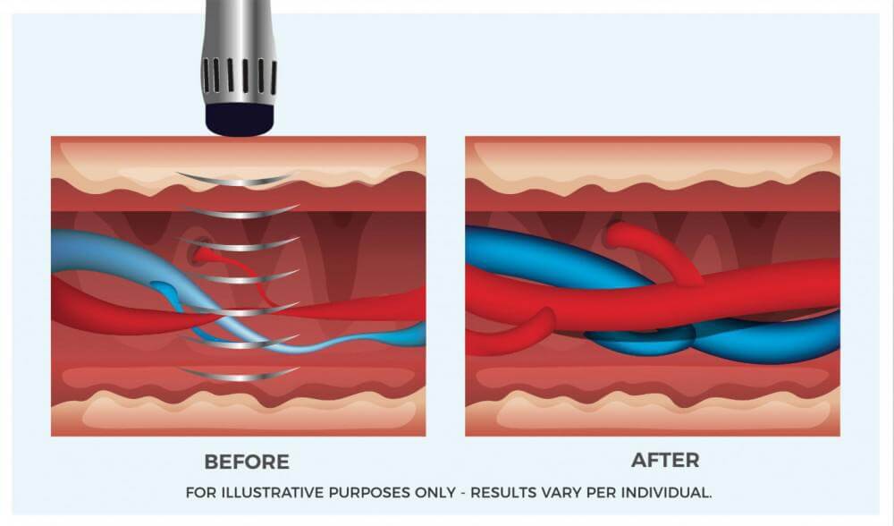 How shockwave therapy works