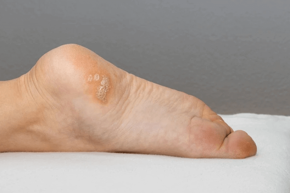 Warts in the foot