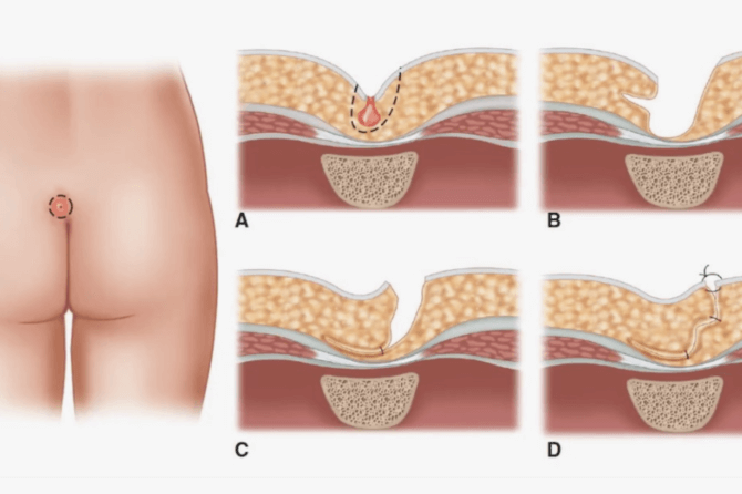 Process of Wart Removal